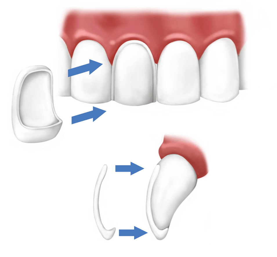 Thickness of dental veneers