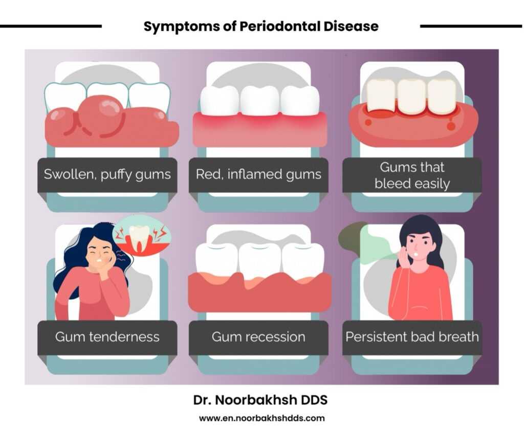 Gum-disease-symptoms