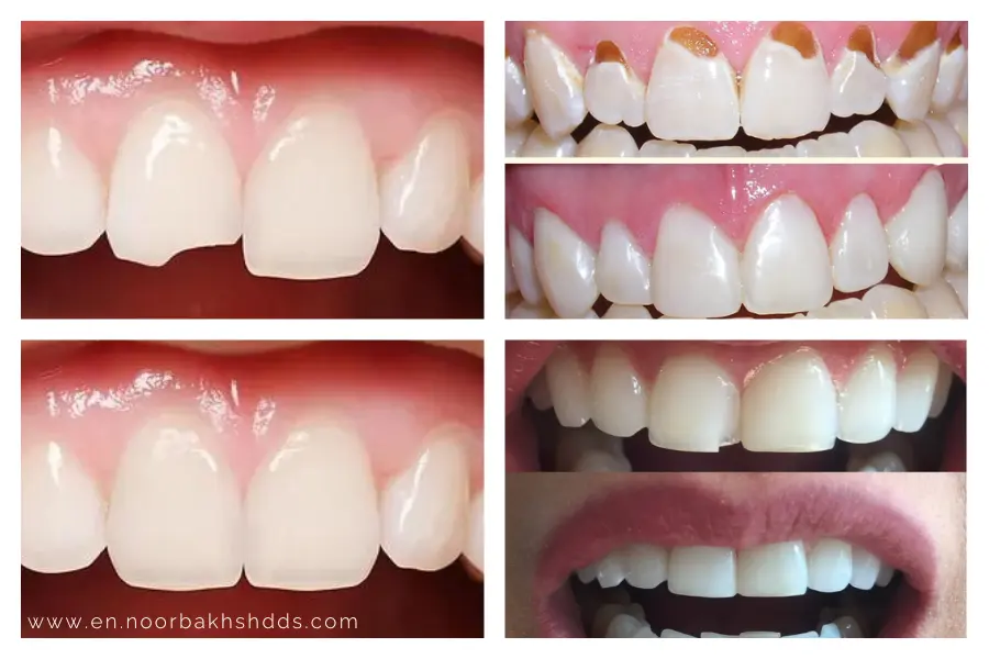 Dental Bonding for Gaps and Minor Imperfections