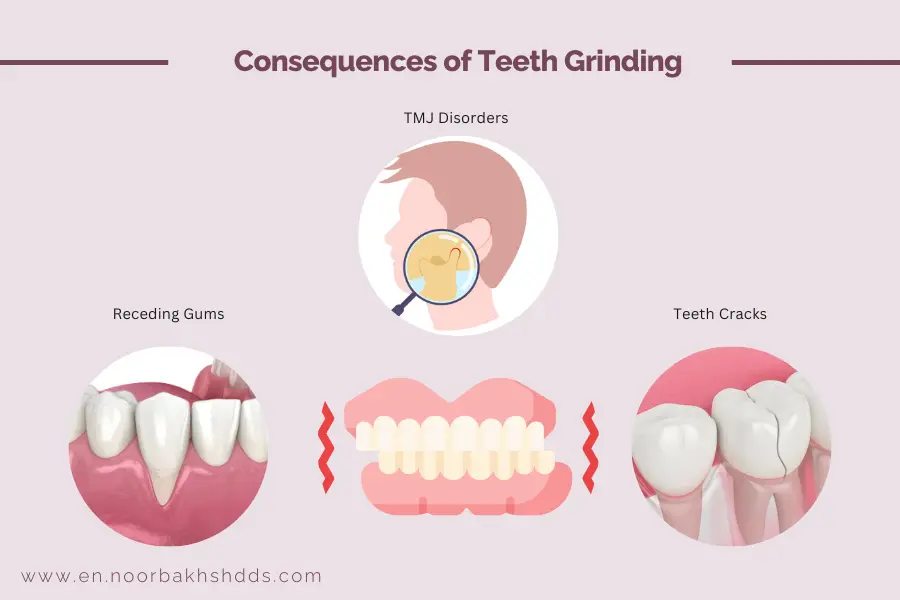 Consequences of teeth grinding: TMJ disorders, Receding gums, and Teeth Cracks