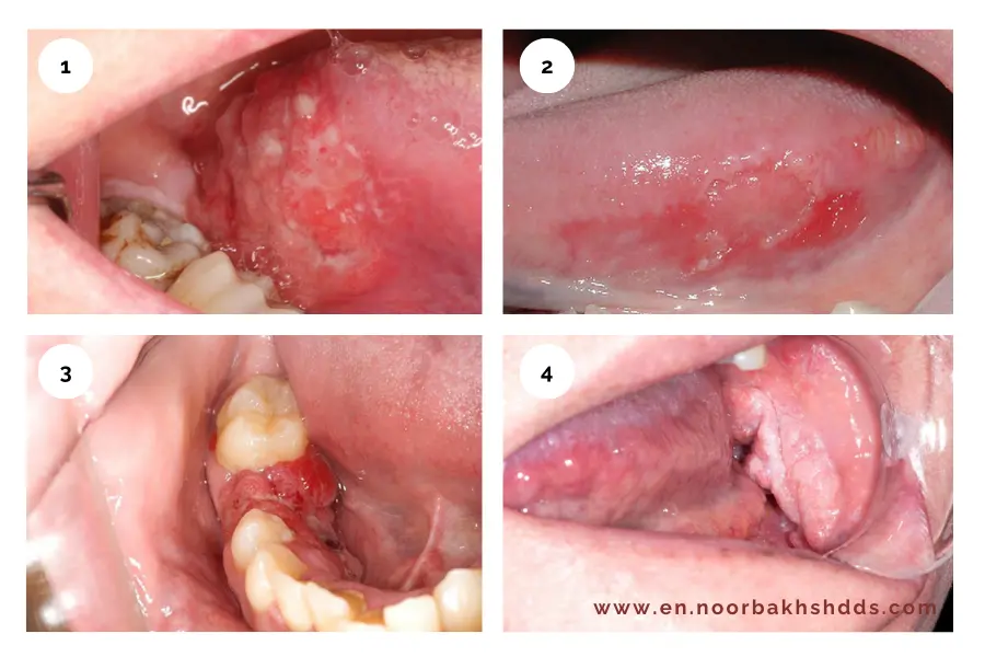 A few symptoms of oral cancer