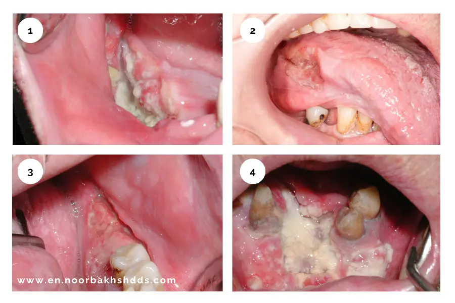 Oral cancer in various parts of the oral cavity.