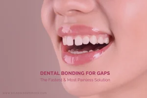 Dental Bonding for Gaps-Blog cover