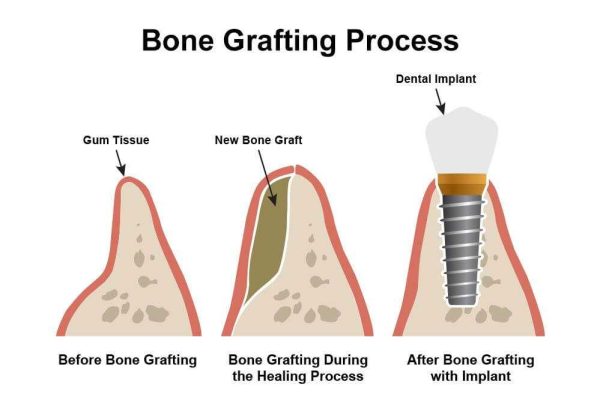 Dental bone grafting