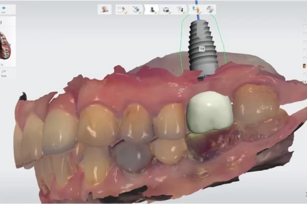 digital dental implant
